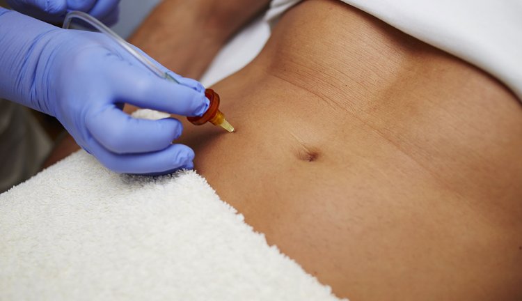 Trattamenti di medicina estetica del corpo